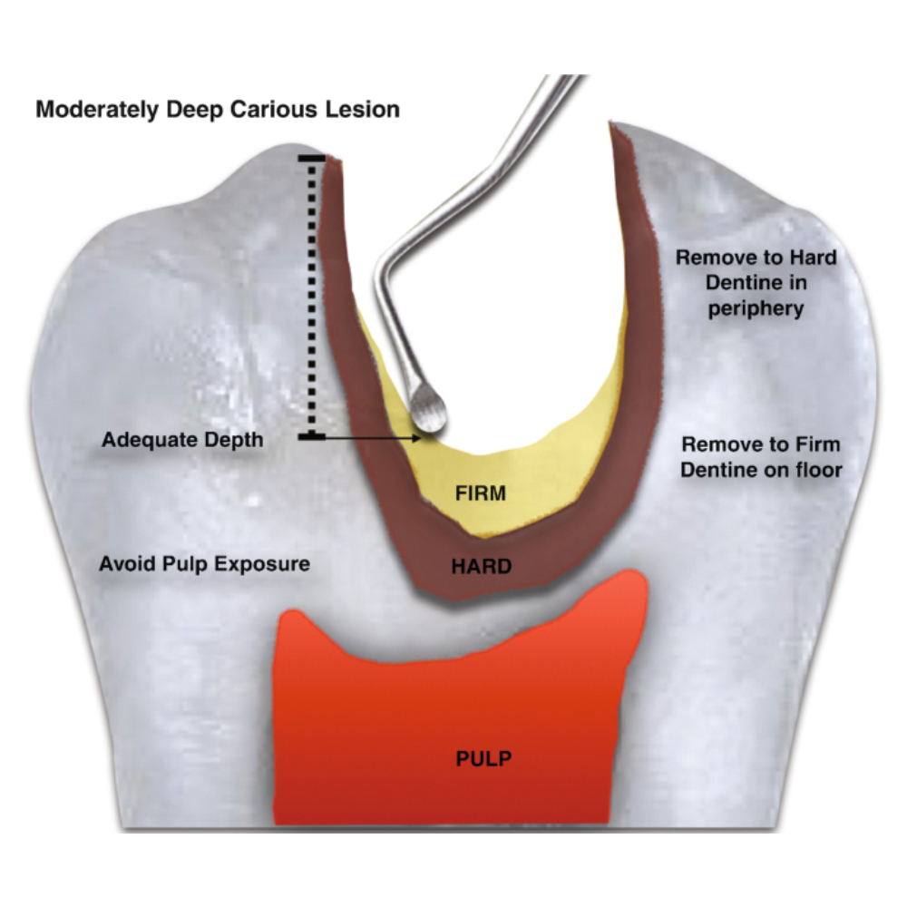 GDC Spoon Excavator #1 Exc125/126