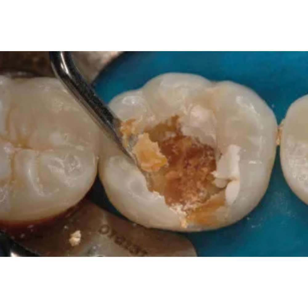 GDC Spoon Excavator Oval Shape #3 EXC31L