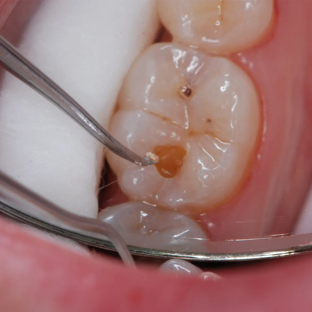 GDC Spoon Excavator -1 (EXC133/134)