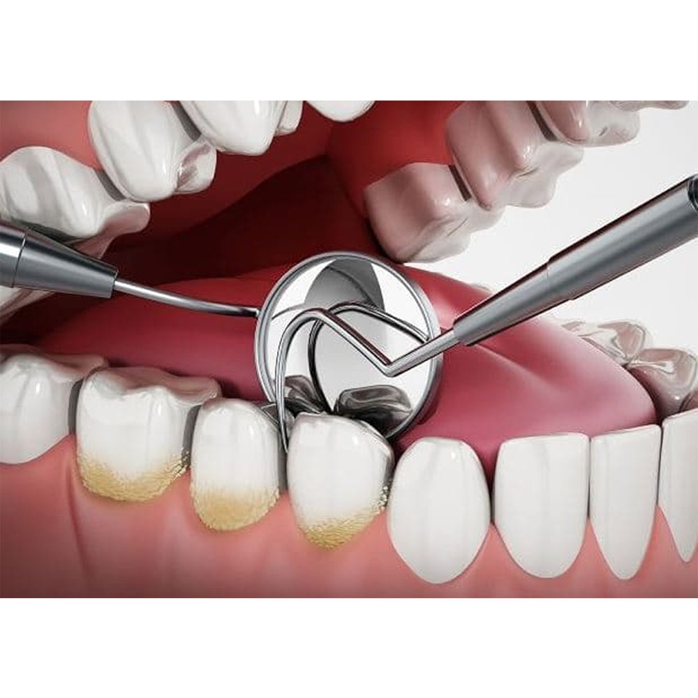 GDC Single End Probe -1 (Exs23)