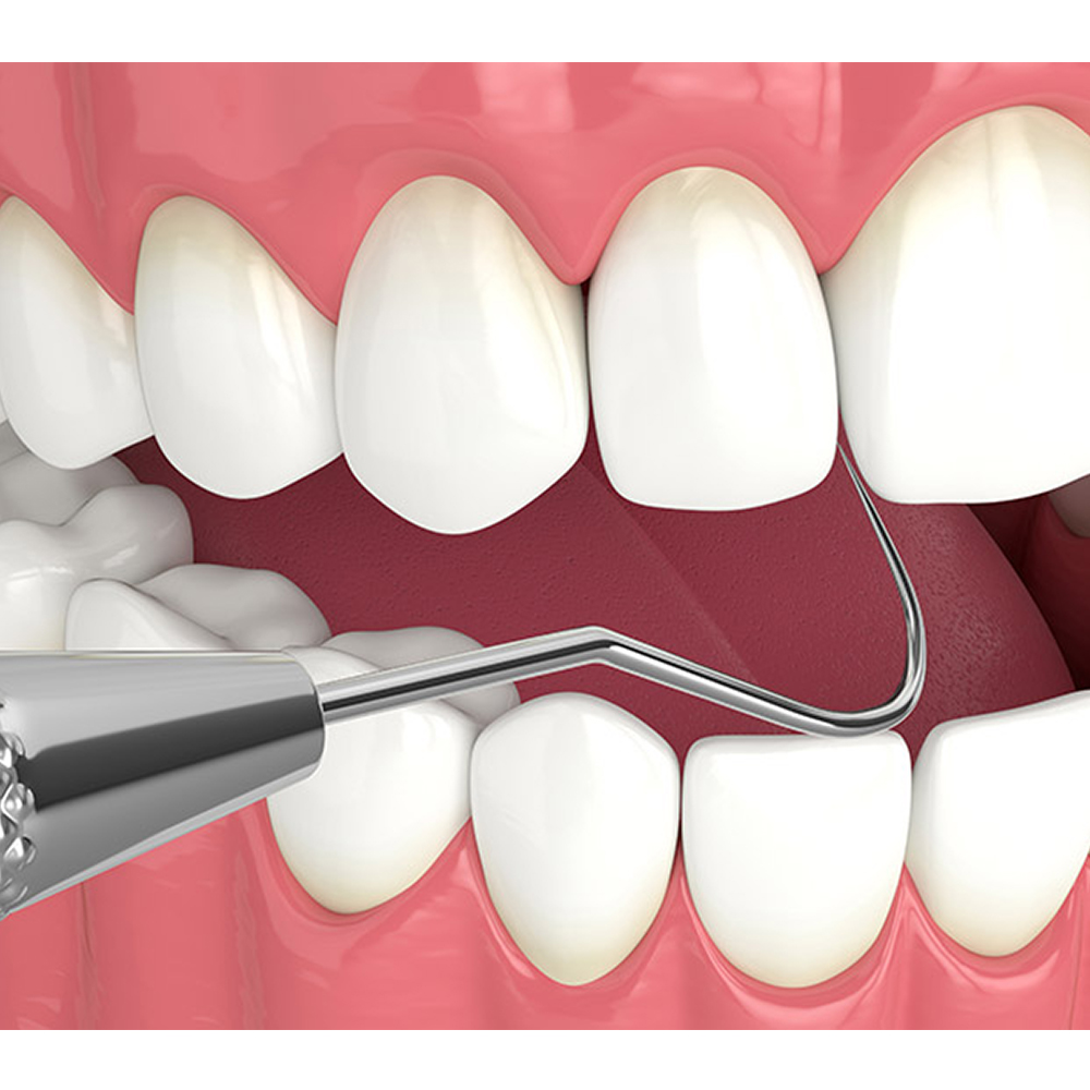GDC Single End Probe -1 (Exs23)