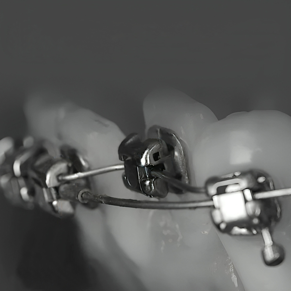 Koden EZ Lock + MBT Metal Self Ligating Bracket Kits With 3 Sets of Cu NiTi Archwires