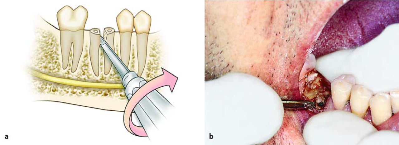 Waldent Root Elevator Instruments Kit Set of 11 K2/4