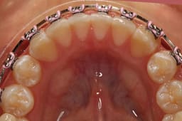 U ortho Niti Reverse Curve Archwire -Rectangular - 18