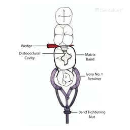 Waldent Matrix Retainer - Ivory No. 1 (8/106) - 9
