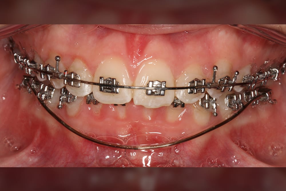 U ortho Niti Reverse Curve Archwire -Rectangular