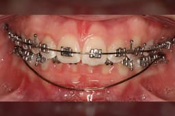 U ortho Niti Reverse Curve Archwire -Rectangular - 17