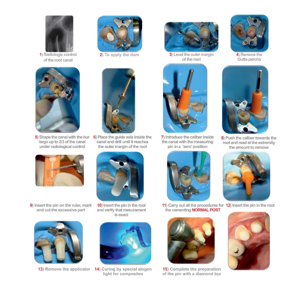 Younique Fiber Site Post Kit