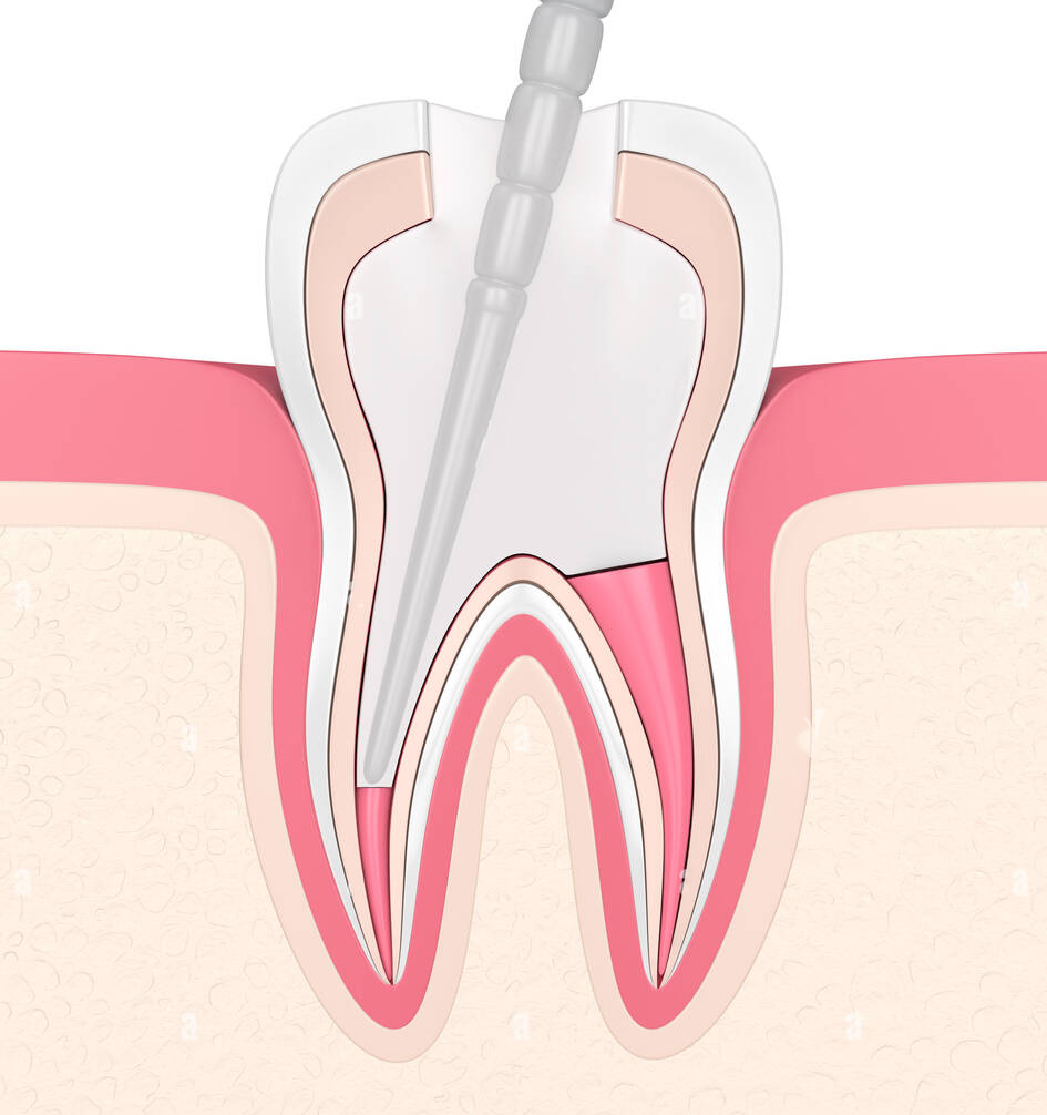 Endoking Fiber Post Refills