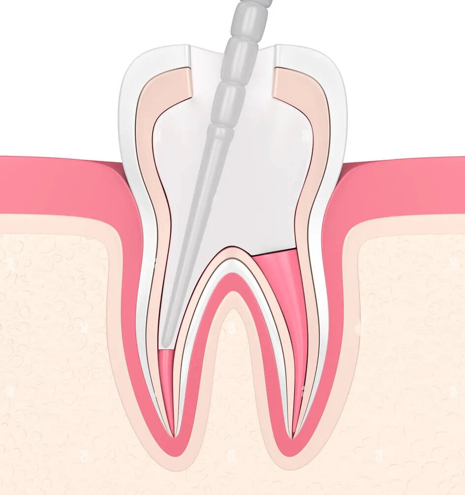 AAA Fiber Post Pack of 10