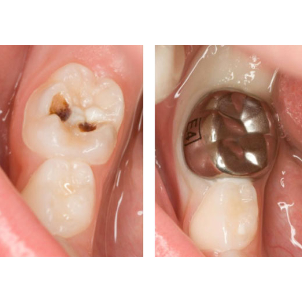 3M ESPE Ss Crown Primary Molar - Intro Kit Nd96