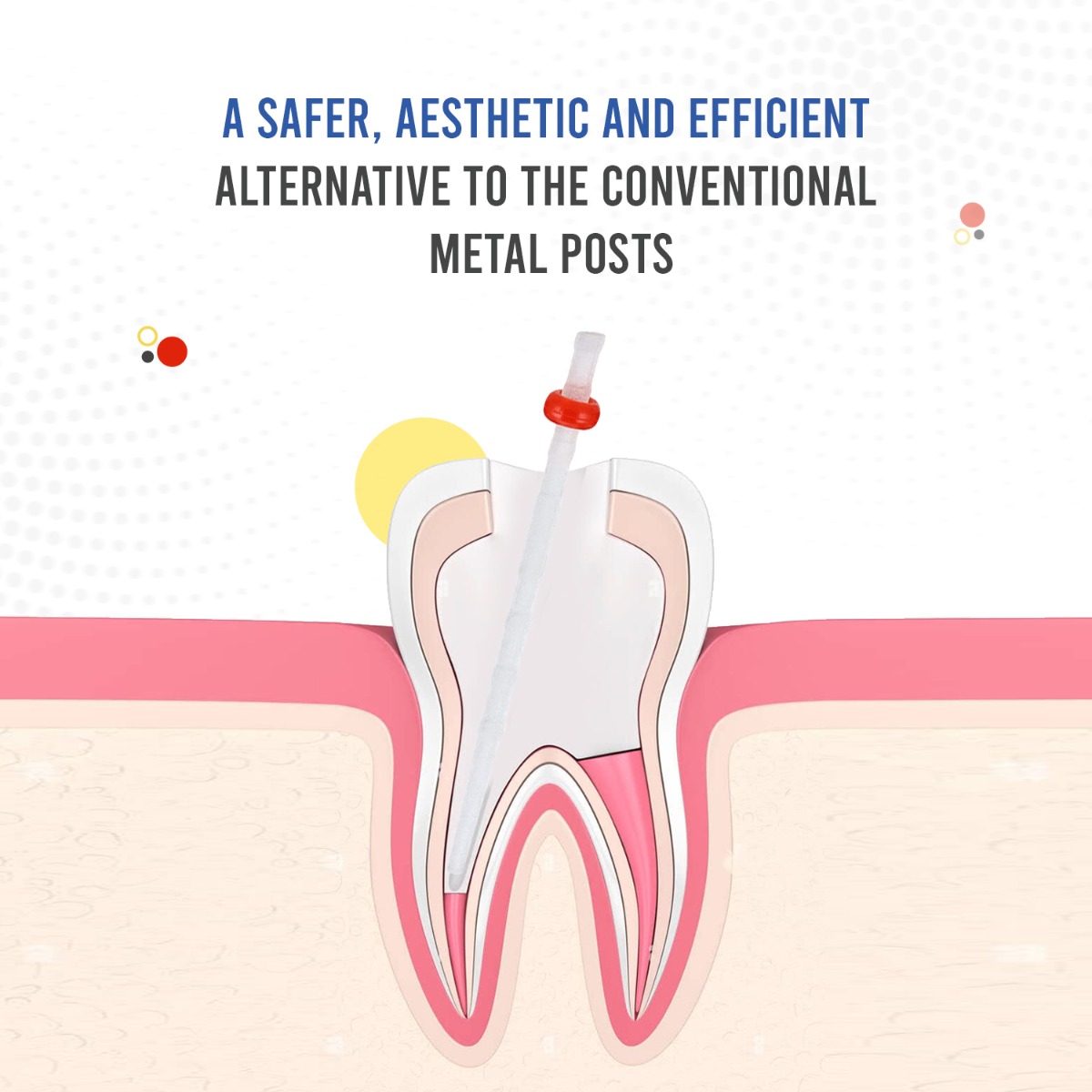 Endoking Fiber Post Refills