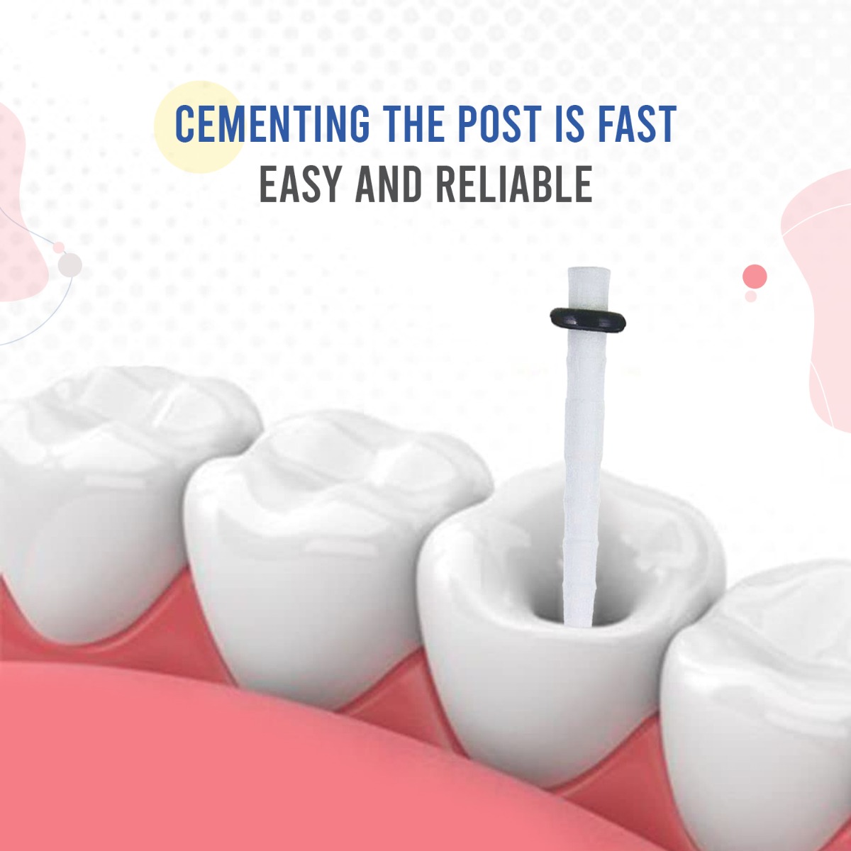 Endoking Fiber Post Refills