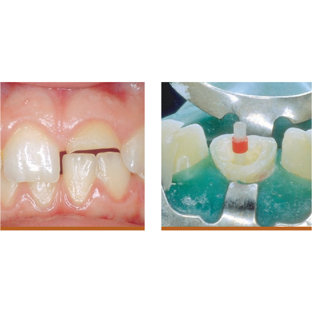 3M ESPE Relyx Fiber Post Refills