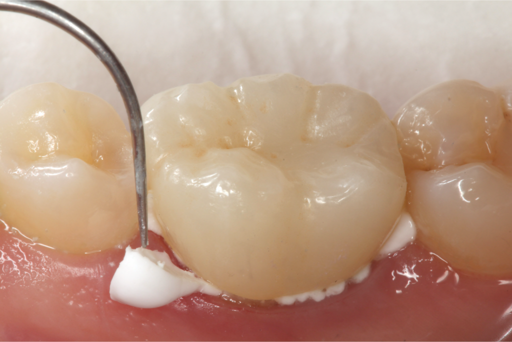 Prevest Crysta GIC Luting I