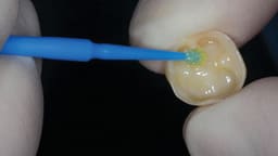 ET Dental Applicator Tips - Regular  - 6