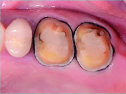 Prime Dental Retra Gel - 4