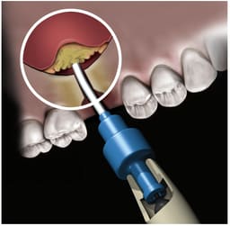 Novabone Dental Putty Cartridge Form - 9