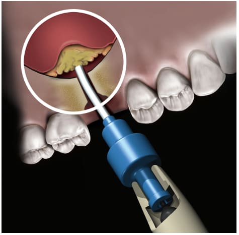 Novabone Dental Putty Cartridge Form