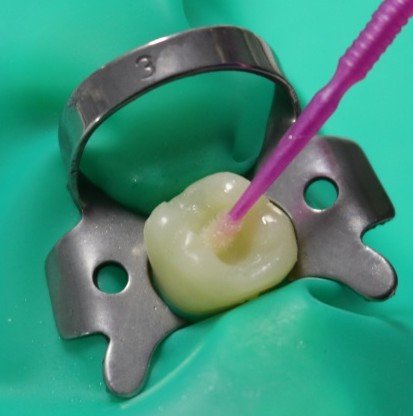 SafeEndo ReCreate Bond 7 (7th Gen Bonding Agent)