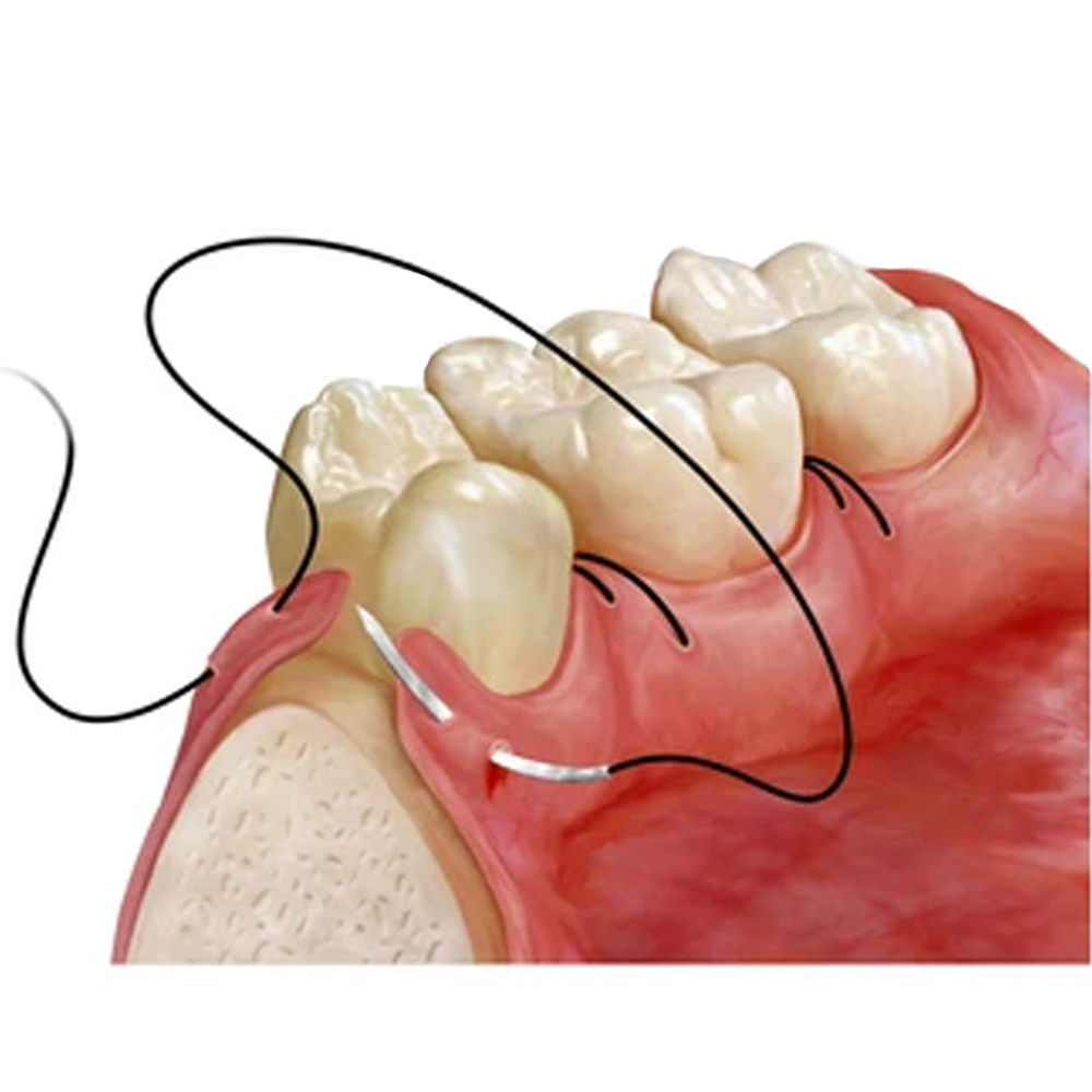 Meril Filasilk #4-0 Black Braided Silk Suture