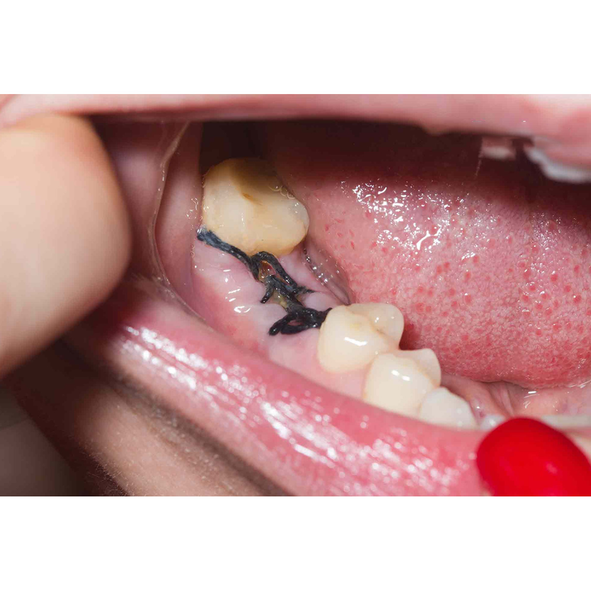 Meril Filaprop #5-0 Polypropylene Suture