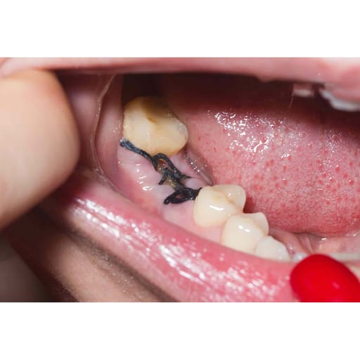 Meril Filaprop #4-0 Polypropylene Suture