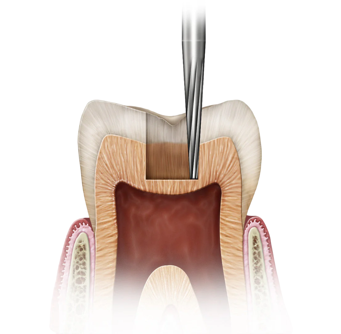 NewDiamond Cross-Cut Taper Fissure FG Airotor Carbide Burs (Pack of 1) 