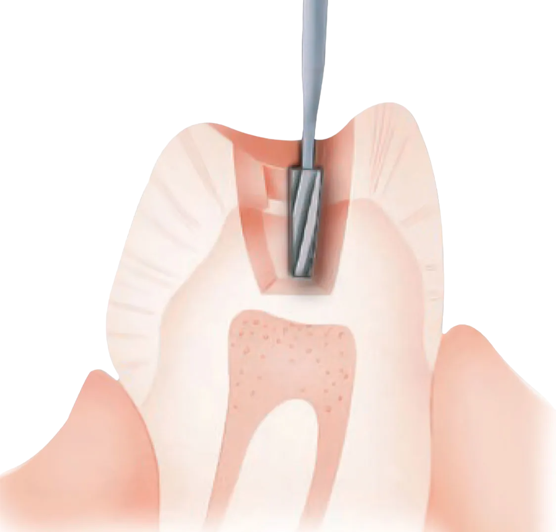 NewDiamond Cross-Cut Taper Fissure FG Airotor Carbide Burs (Pack of 1) 