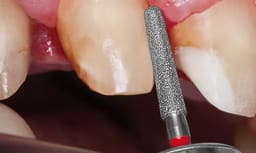 Mani Diamond Airotor Burs CE Series - 15