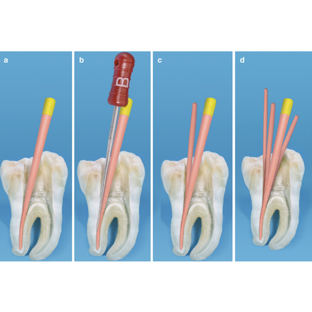 Waldent Finger Spreaders 21mm (Pack of 6)