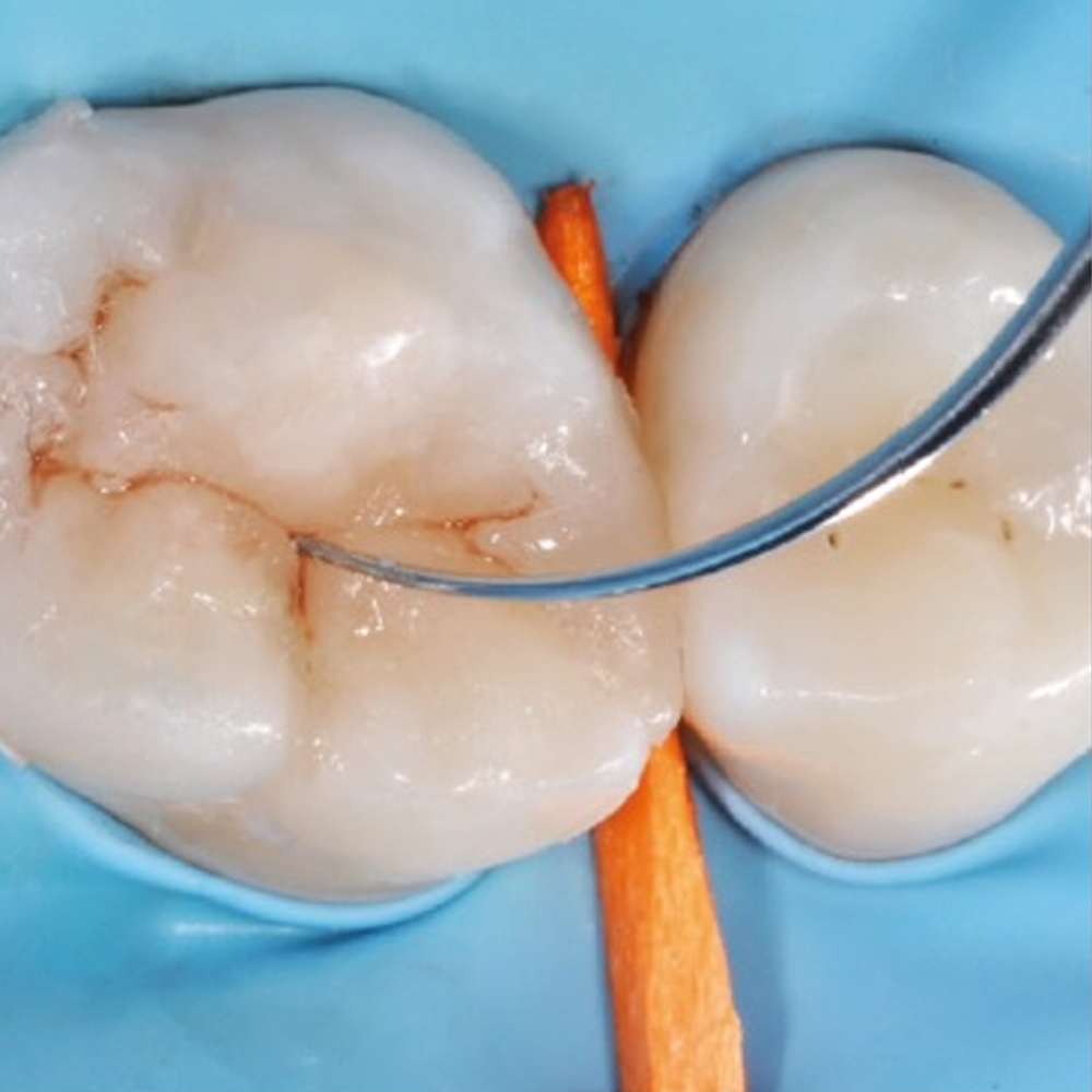 GDC Restore Instrument - Fissura