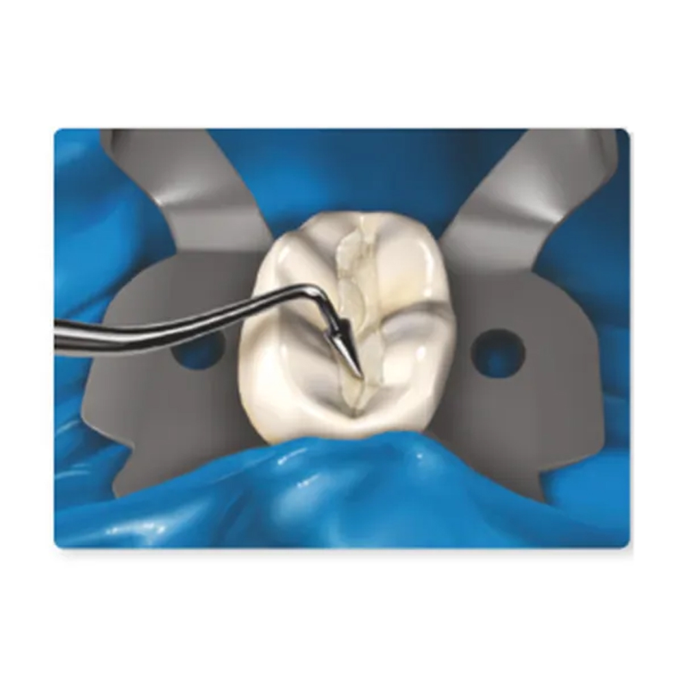 GDC Restore Instrument - Fissura