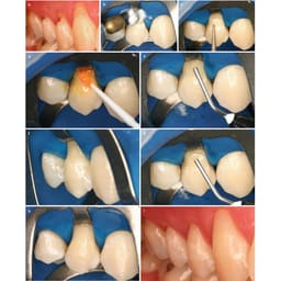 Prime Dental Restorite Flow Viscous Kit - 5