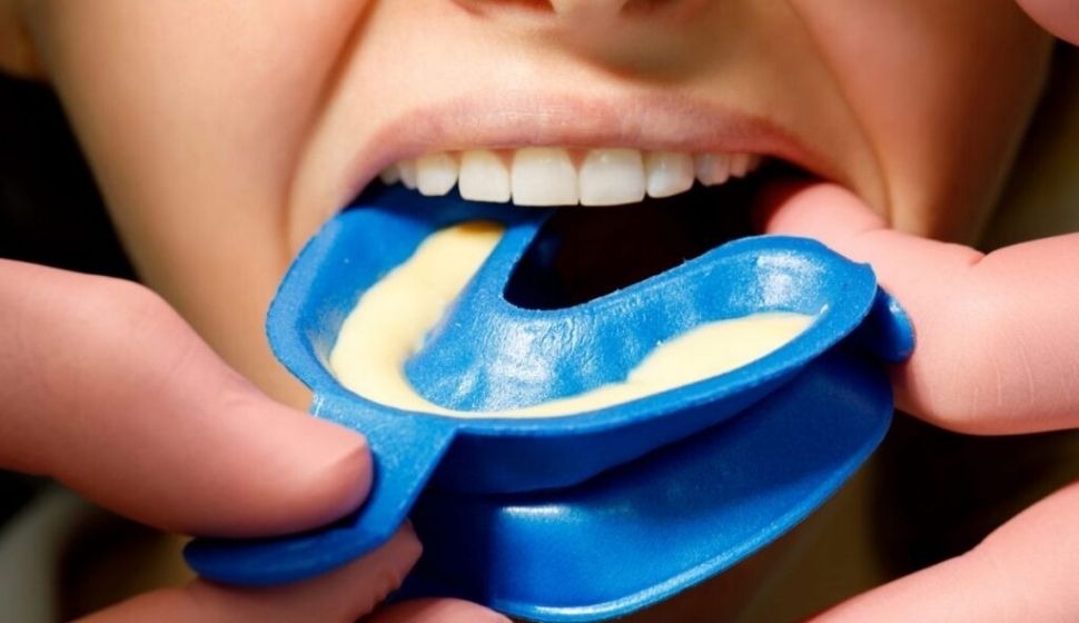 Oro Disposable Fluoride Impression Trays