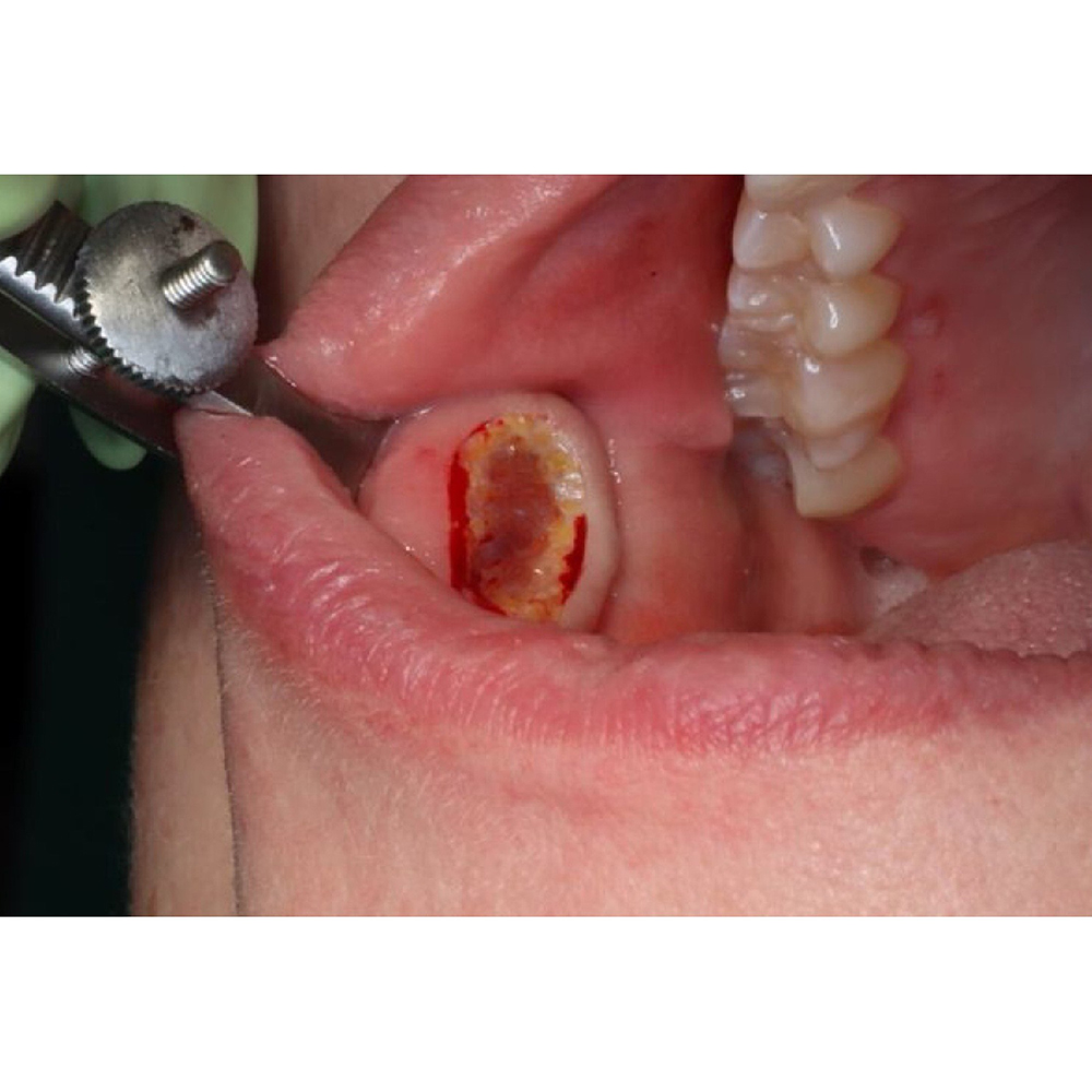 Julldent Chalazion Forceps