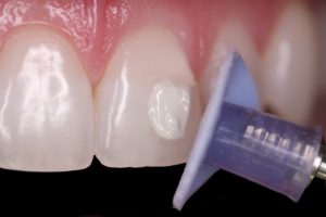 Shofu Direct Dia Diamond Polishing Paste