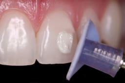 Shofu Direct Dia Diamond Polishing Paste - 5