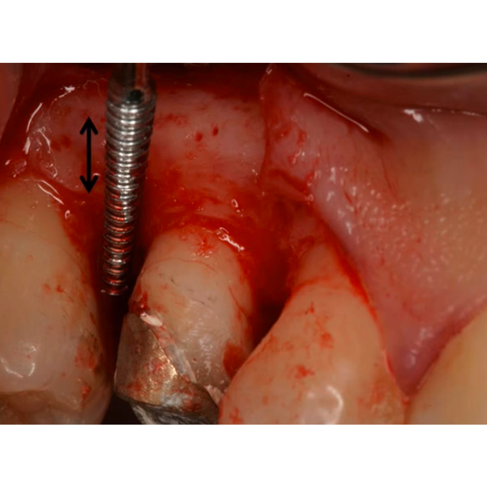 GDC Periodontal Sugarman Bone File#6 (Fs3/4s)