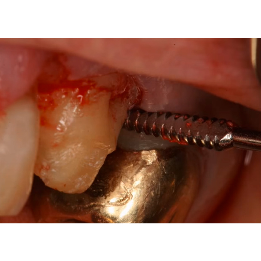 GDC Periodontal Sugarman Bone File#1 (Fs3/4s)