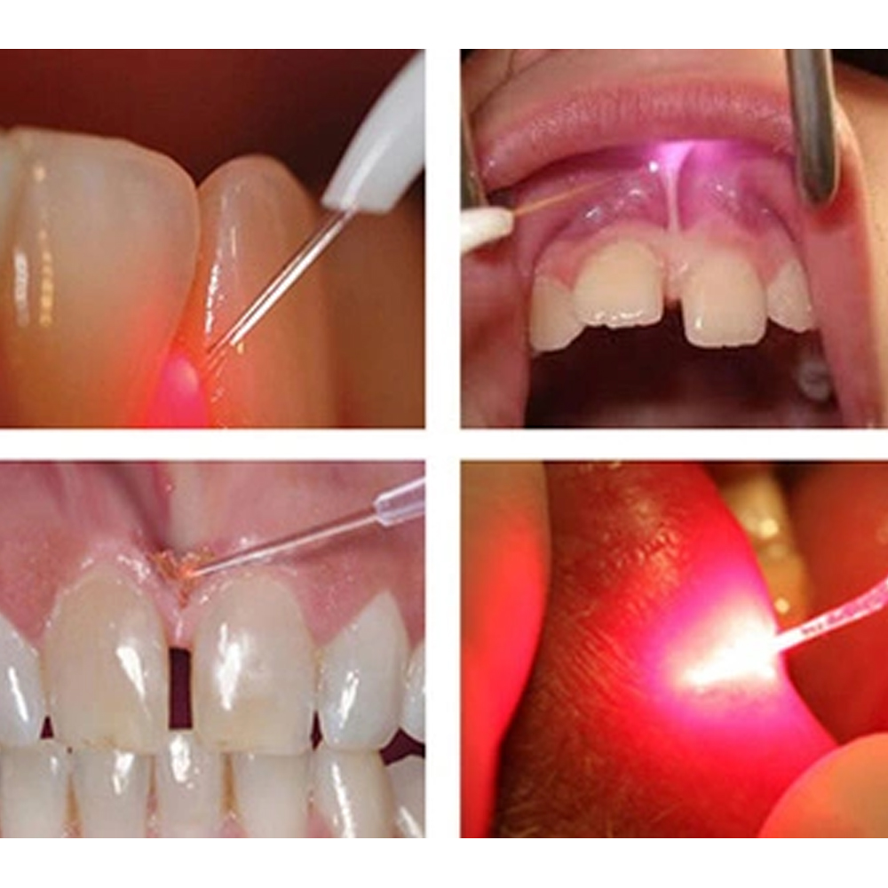 Woodpecker LX16 Diode Laser Tips (Pack of 3)