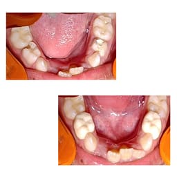Pedo Crown Primary Molar Kits - 7