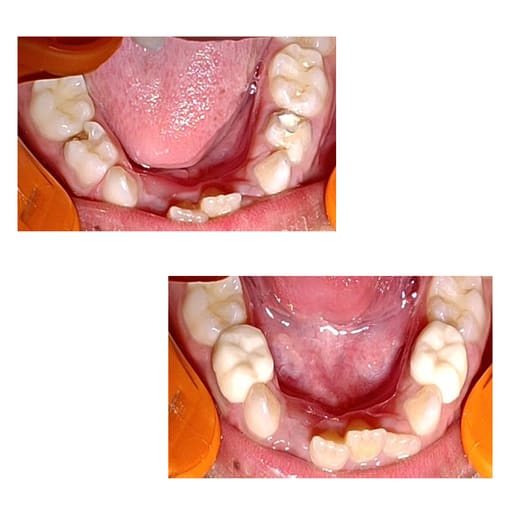 Pedo Crown Primary Molar Kits