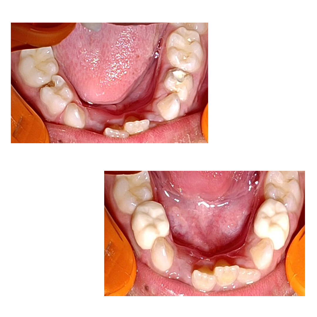Pedo Crown Primary Molar Mini Kits