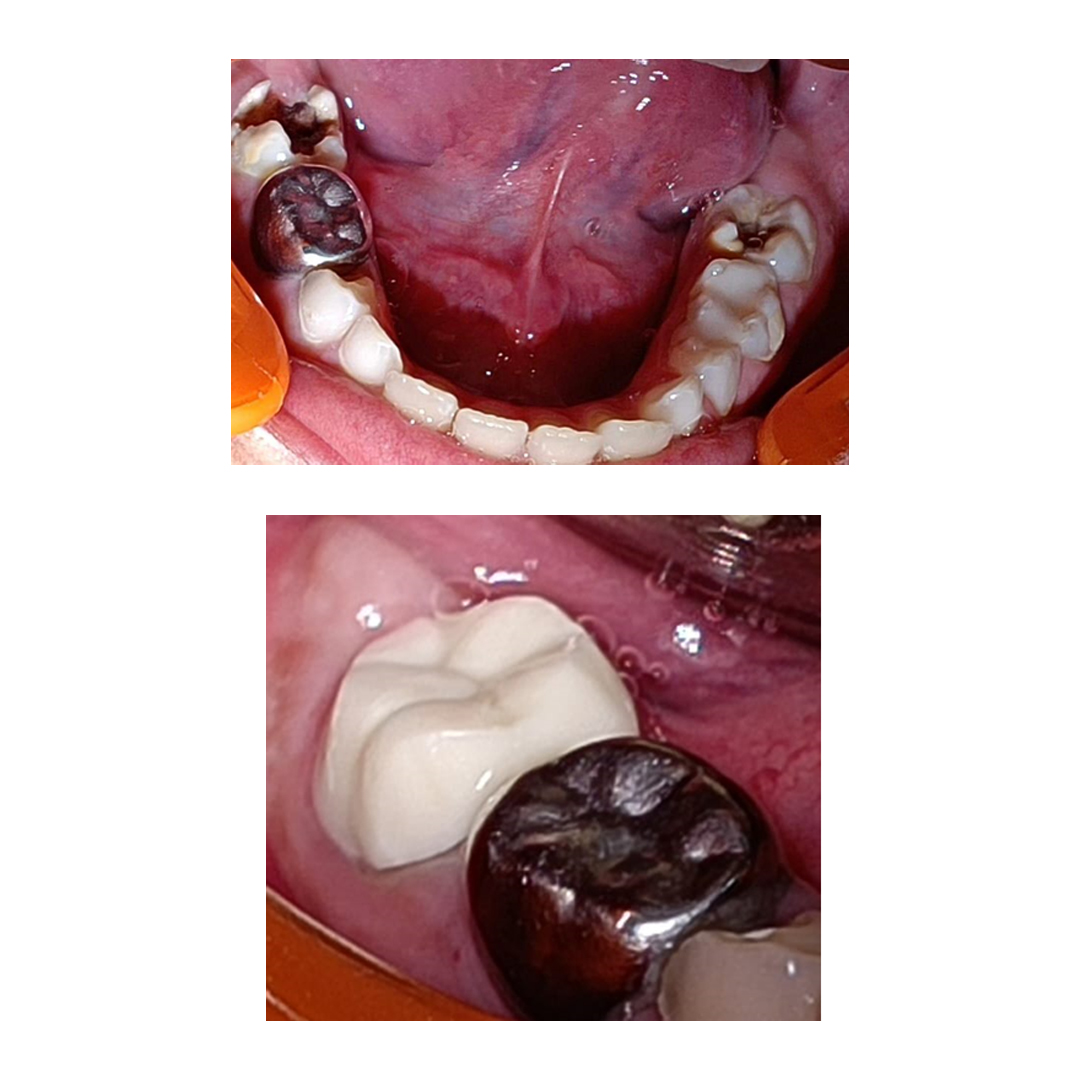 Pedo Crown Primary Molar Mini Kits