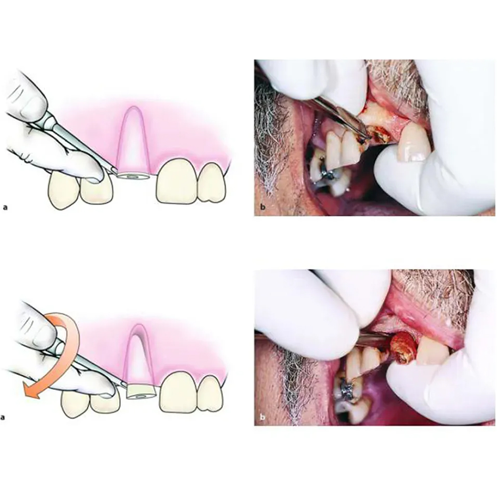 GDC Root Elevators Coupland Standard (Ea2c)