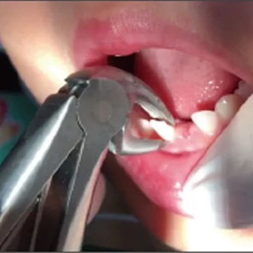 GDC Extraction Forceps Lower Premolars Pedo Standard (FX1CS)