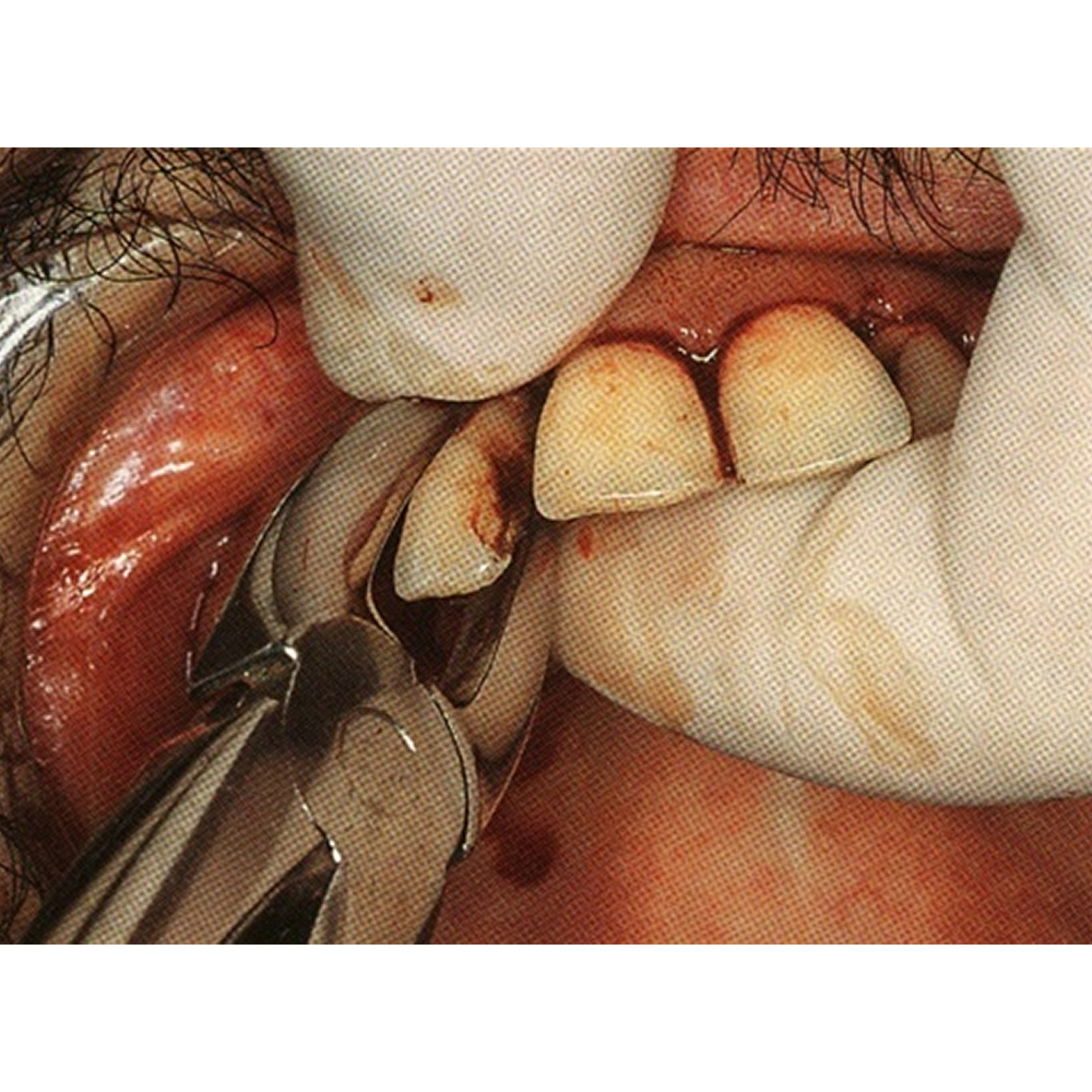 GDC Extraction Forceps Upper Centrals And Canines - 1 Atraumatic (AFX1)