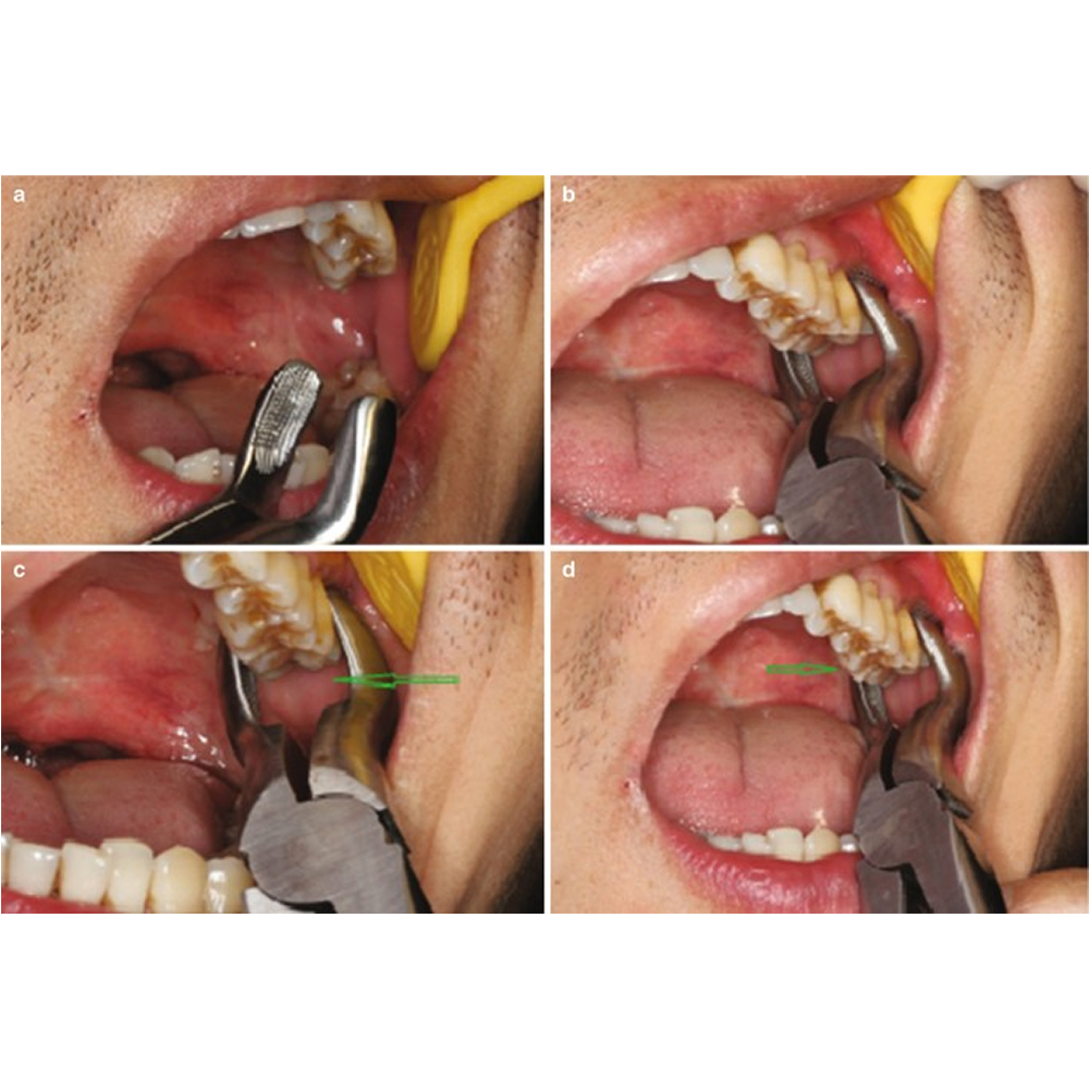 GDC Extraction Forceps Upper Third Molars - 67a Premium (Fx67ap)