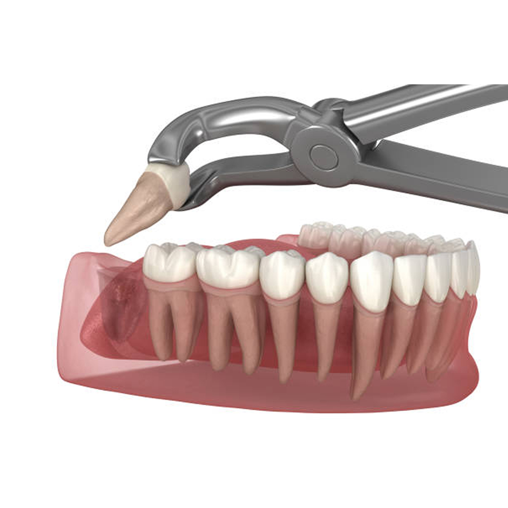 GDC Extraction Forceps Atraumatic